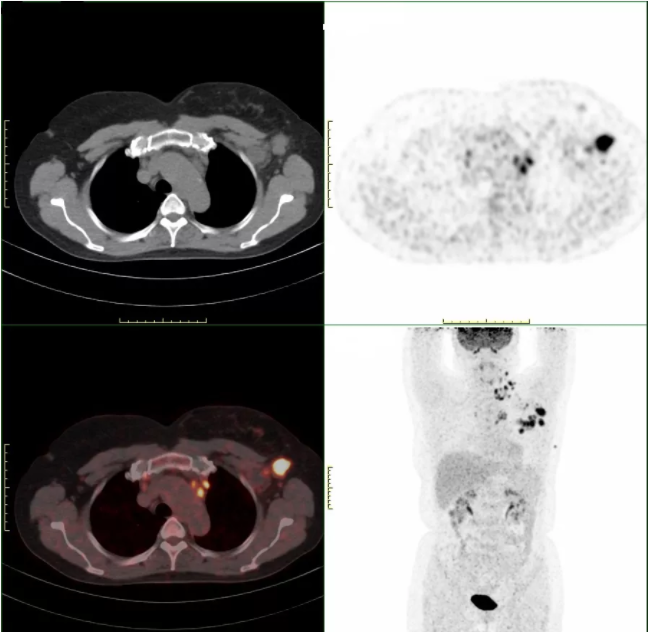 PET-CT：肿瘤检查“核”武器